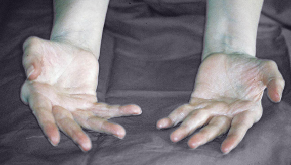 Ulnar deviation of the fingers